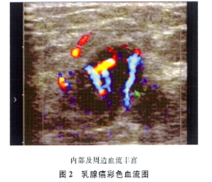 乳腺癌的高频彩色多普勒超声诊断分析